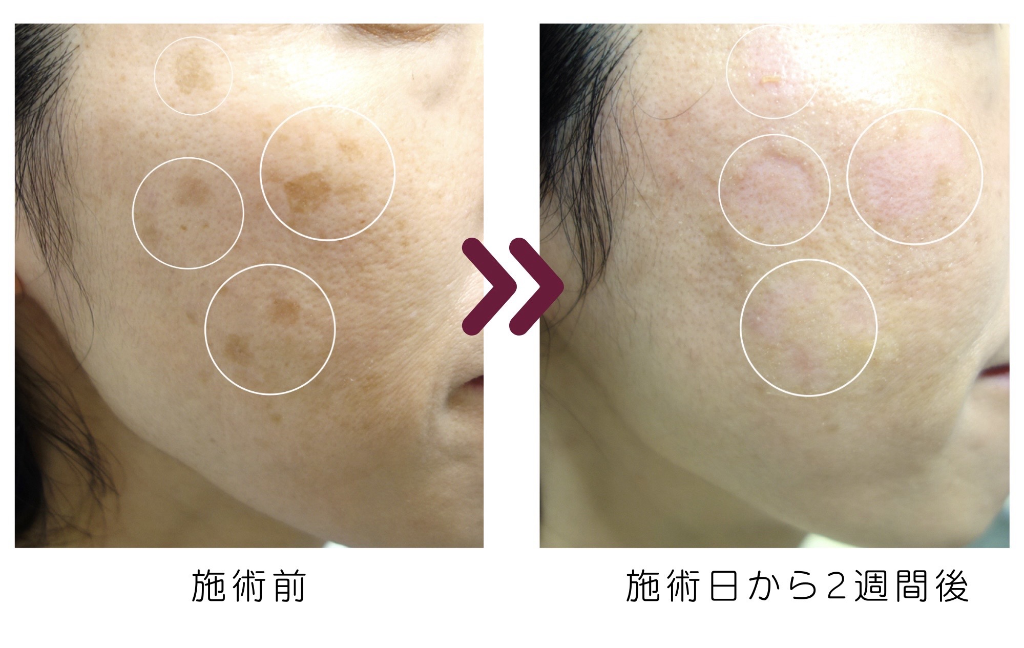 Qスイッチレーザー治療のご案内 | 新着情報 | シスターズ皮フ科l岡山